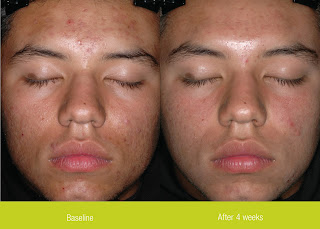 Accutane requirements for taking